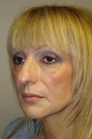 Rhinoplasty Before and After 44 | Grover Aesthetics