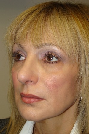 Rhinoplasty Before and After 44 | Grover Aesthetics