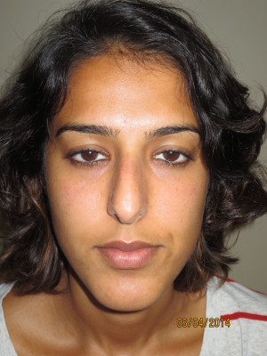 Rhinoplasty Before and After 44 | Sanjay Grover MD FACS