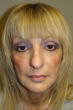 Rhinoplasty Before and After 44 | Grover Aesthetics