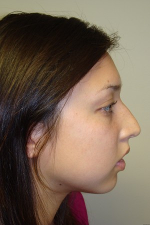 Rhinoplasty Before and After | Grover Aesthetics