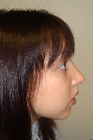 Rhinoplasty Before and After | Grover Aesthetics