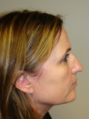 Rhinoplasty Before and After | Grover Aesthetics