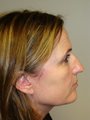 Rhinoplasty Before and After 16 | Sanjay Grover MD FACS