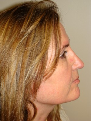 Rhinoplasty Before and After | Grover Aesthetics