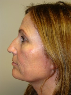 Rhinoplasty Before and After 46 | Sanjay Grover MD FACS