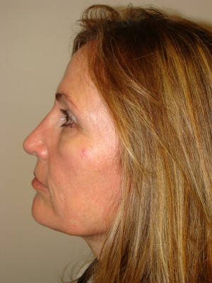 Rhinoplasty Before and After 46 | Grover Aesthetics
