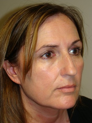 Rhinoplasty Before and After 46 | Grover Aesthetics