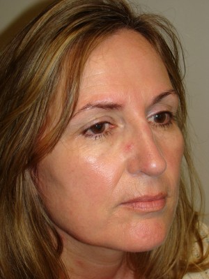 Rhinoplasty Before and After 46 | Grover Aesthetics