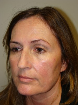 Rhinoplasty Before and After 46 | Grover Aesthetics