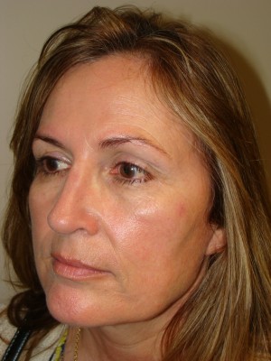 Rhinoplasty Before and After 46 | Grover Aesthetics