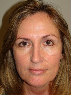 Rhinoplasty Before and After 46 | Grover Aesthetics