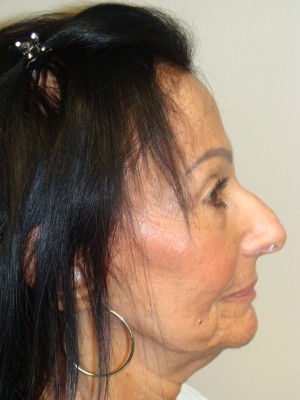 Rhinoplasty Before and After | Grover Aesthetics