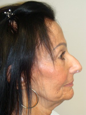 Rhinoplasty Before and After | Sanjay Grover MD FACS