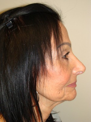 Rhinoplasty Before and After | Grover Aesthetics