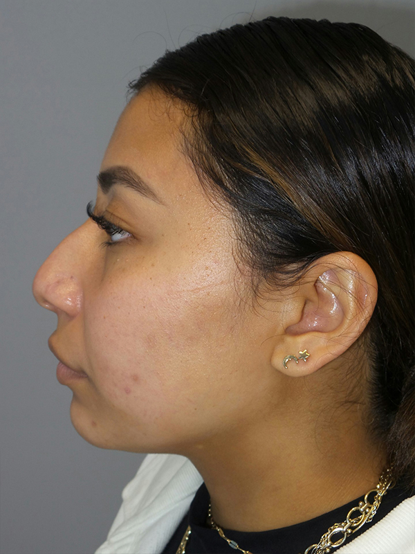 Rhinoplasty Before and After 47 | Sanjay Grover MD FACS