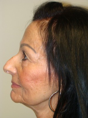 Rhinoplasty Before and After 47 | Sanjay Grover MD FACS