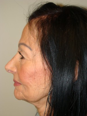 Rhinoplasty Before and After 47 | Grover Aesthetics