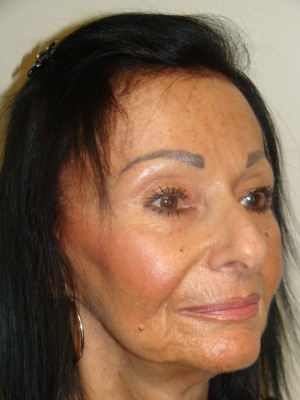 Rhinoplasty Before and After 47 | Grover Aesthetics
