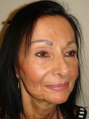 Rhinoplasty Before and After 47 | Grover Aesthetics