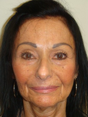 Rhinoplasty Before and After 47 | Grover Aesthetics