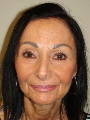 Rhinoplasty Before and After 47 | Grover Aesthetics