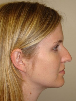 Rhinoplasty Before and After 38 | Sanjay Grover MD FACS