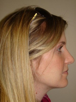 Rhinoplasty Before and After | Grover Aesthetics