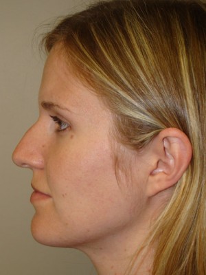 Rhinoplasty Before and After 48 | Sanjay Grover MD FACS