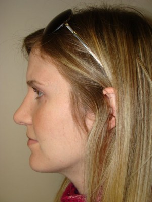 Rhinoplasty Before and After 48 | Grover Aesthetics