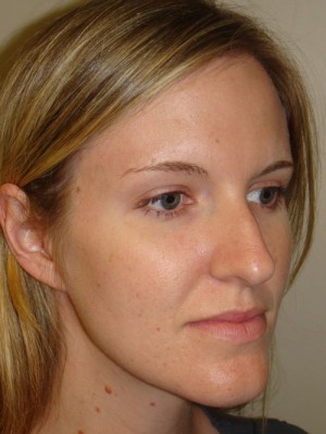 Rhinoplasty Before and After 48 | Grover Aesthetics