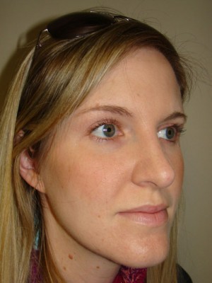 Rhinoplasty Before and After 48 | Grover Aesthetics