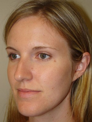 Rhinoplasty Before and After 48 | Grover Aesthetics