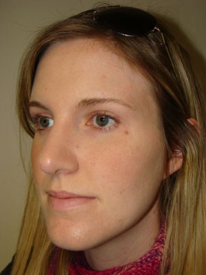 Rhinoplasty Before and After 48 | Grover Aesthetics