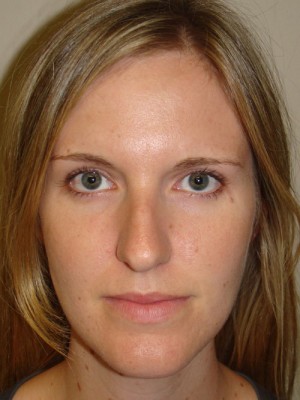 Rhinoplasty Before and After 48 | Grover Aesthetics