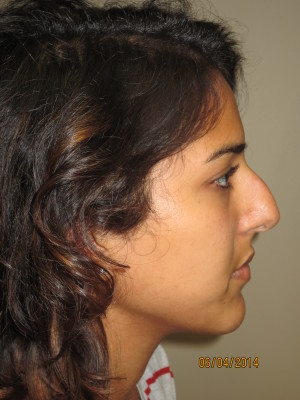 Rhinoplasty Before and After | Grover Aesthetics