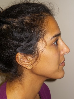 Rhinoplasty Before and After | Grover Aesthetics
