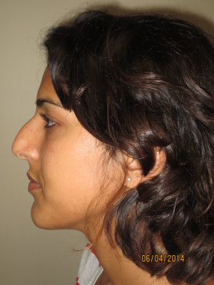 Rhinoplasty Before and After 49 | Grover Aesthetics