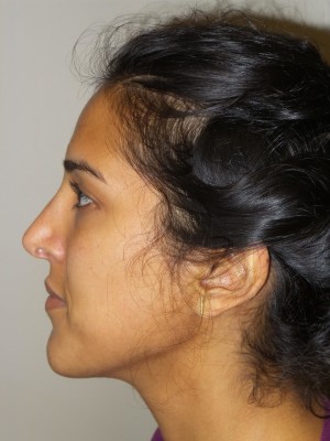 Rhinoplasty Before and After 49 | Sanjay Grover MD FACS