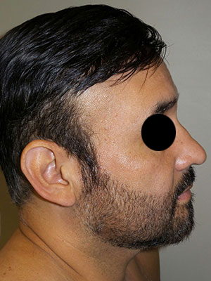 Rhinoplasty Before and After | Grover Aesthetics