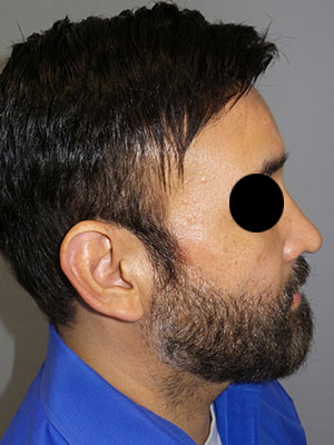 Rhinoplasty Before and After | Grover Aesthetics