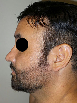 Rhinoplasty Before and After 50 | Grover Aesthetics
