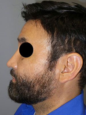 Rhinoplasty Before and After 50 | Grover Aesthetics