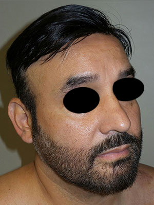 Rhinoplasty Before and After 50 | Grover Aesthetics