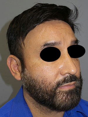 Rhinoplasty Before and After 50 | Grover Aesthetics