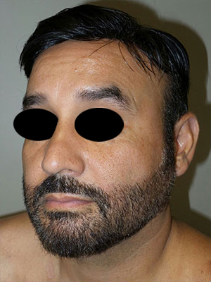 Rhinoplasty Before and After 50 | Grover Aesthetics