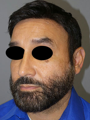 Rhinoplasty Before and After 50 | Grover Aesthetics