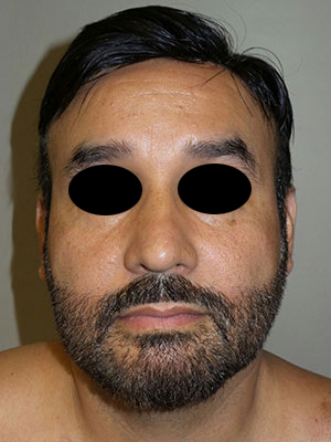 Rhinoplasty Before and After 50 | Grover Aesthetics