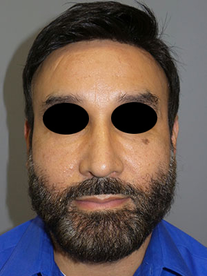 Rhinoplasty Before and After 50 | Grover Aesthetics