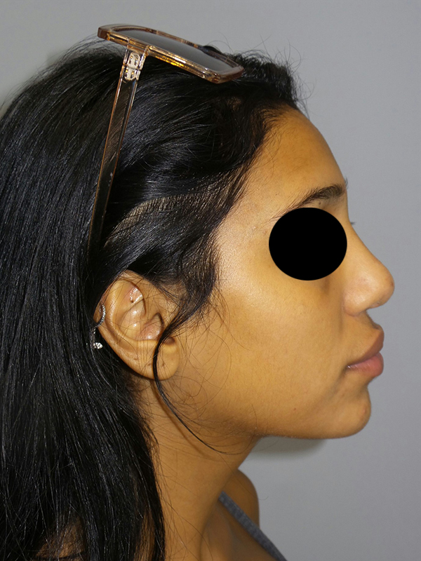 Rhinoplasty Before and After | Grover Aesthetics